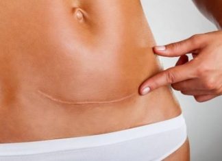 Με καισαρική το 56,8% των γεννήσεων στην Ελλάδα