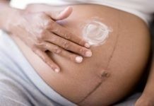 Tips για να αποφύγεις τις ραγάδες στην εγκυμοσύνη