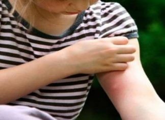 Να τι πρέπει να κάνεις αν τσιμπήσει το παιδί σου μέλισσα