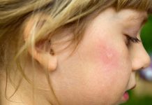 Οι ειδικοί συμβουλεύουν: Tips για να μην τσιμπήσει το παιδί σου κουνούπι