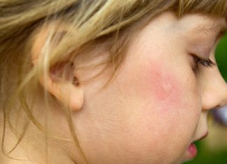 Οι ειδικοί συμβουλεύουν: Tips για να μην τσιμπήσει το παιδί σου κουνούπι