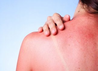 Αντιμετώπισε το κάψιμο από την ήλιο με… φυσικό τρόπο!